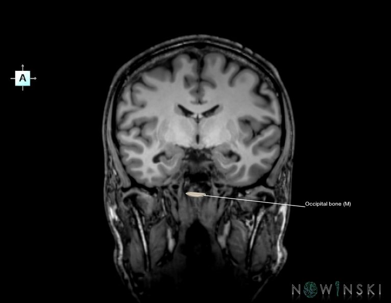 G6.T22.5.6.V1.P-10S.Occipital_bone–Triplanar.tiff