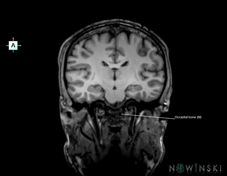 G6.T22.5.6.V1.P-20.Occipital_bone–Triplanar.tiff