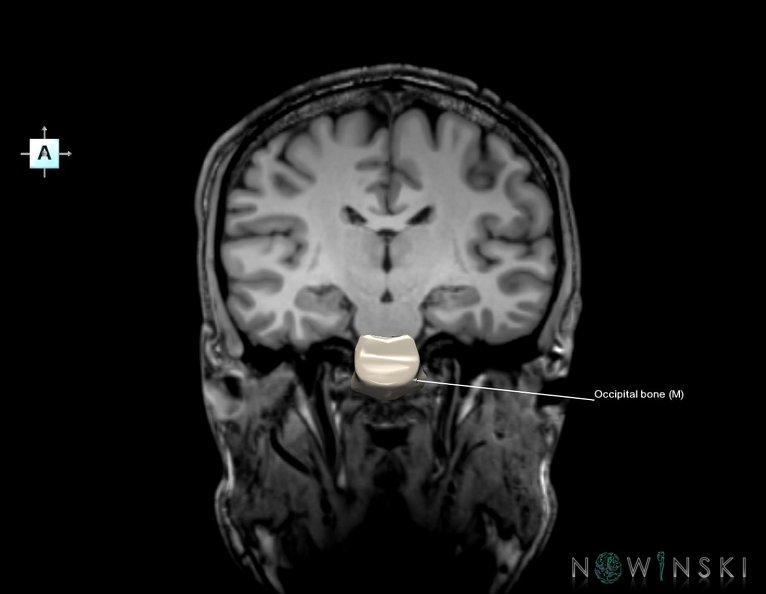 G6.T22.5.6.V1.P-20S.Occipital_bone–Triplanar.tiff