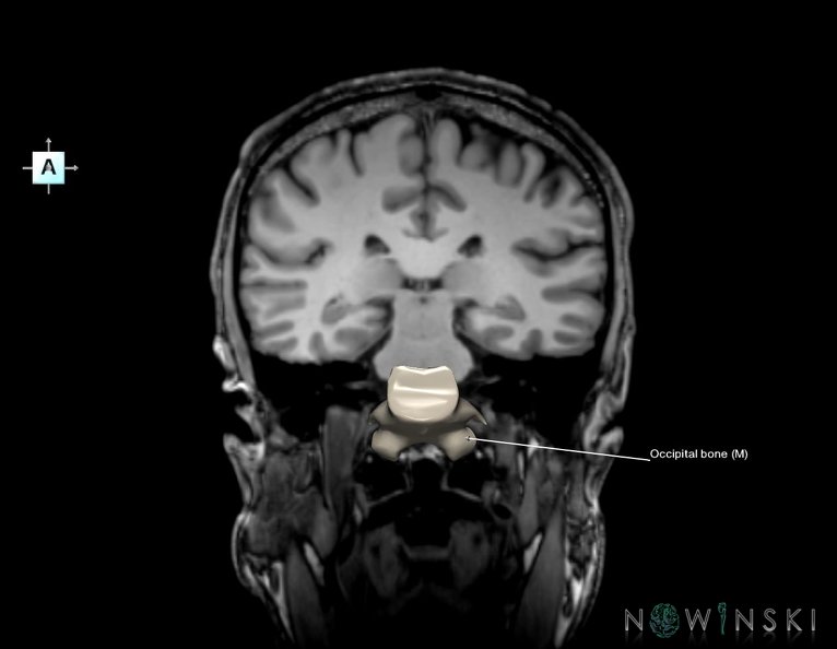 G6.T22.5.6.V1.P-30S.Occipital_bone–Triplanar.tiff