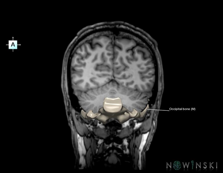 G6.T22.5.6.V1.P-60S.Occipital_bone–Triplanar.tiff