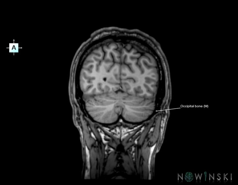 G6.T22.5.6.V1.P-70.Occipital_bone–Triplanar.tiff