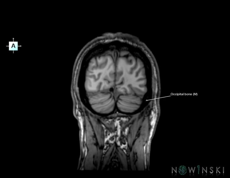 G6.T22.5.6.V1.P-80.Occipital_bone–Triplanar.tiff