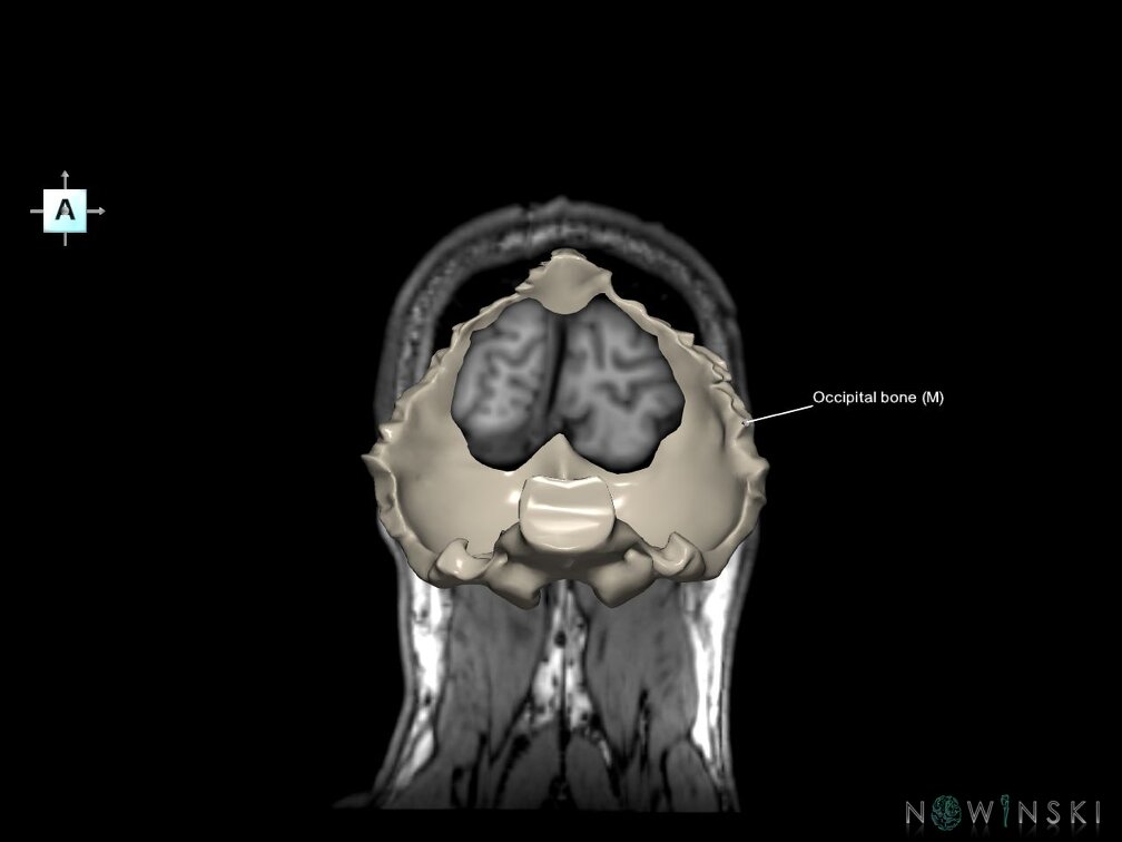 G6.T22.5.6.V1.P-90S.Occipital bone–Triplanar