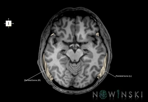 G6.T22.5.7.V6.P-10S.Parietal bone–Triplanar