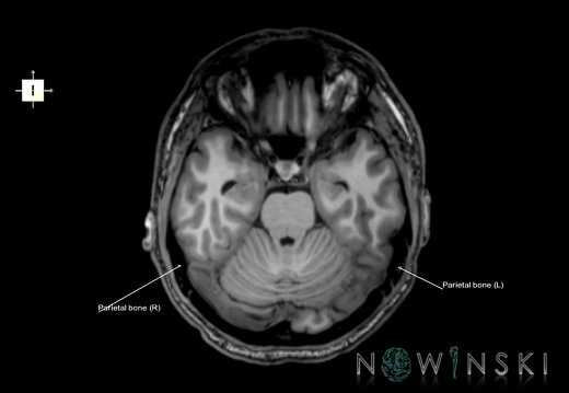 G6.T22.5.7.V6.P-20.Parietal bone–Triplanar