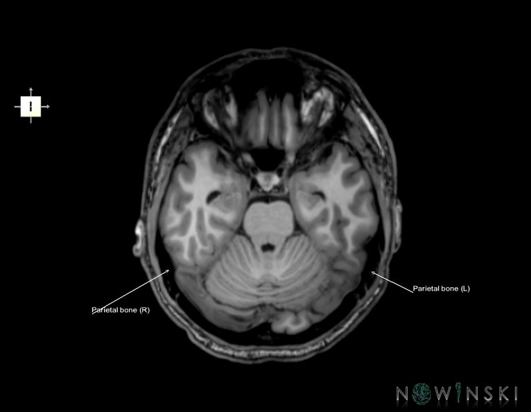 G6.T22.5.7.V6.P-20.Parietal_bone–Triplanar.tiff