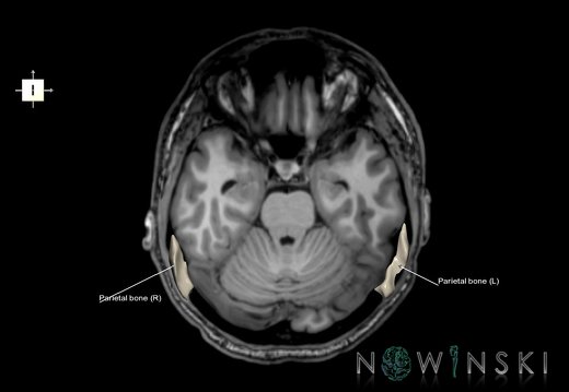 G6.T22.5.7.V6.P-20S.Parietal bone–Triplanar