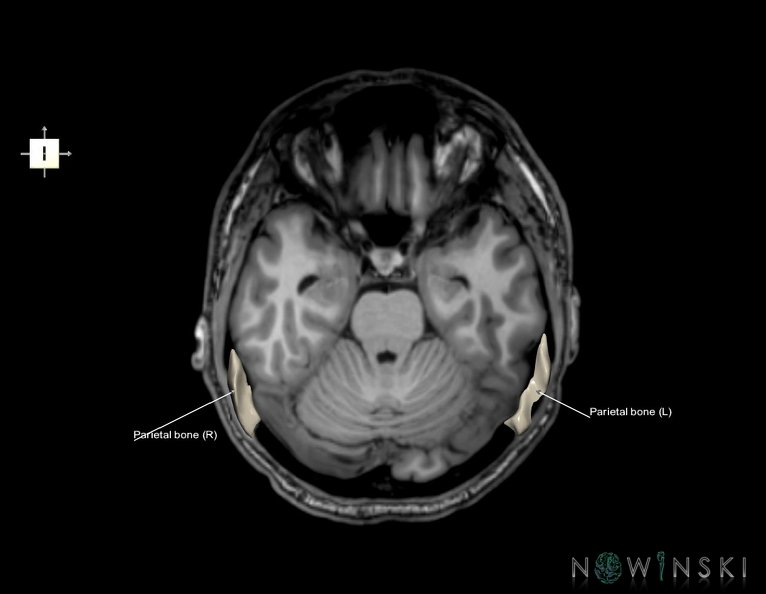 G6.T22.5.7.V6.P-20S.Parietal_bone–Triplanar.tiff