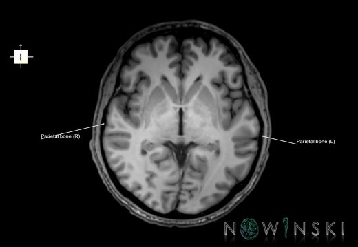 G6.T22.5.7.V6.P00.Parietal bone–Triplanar