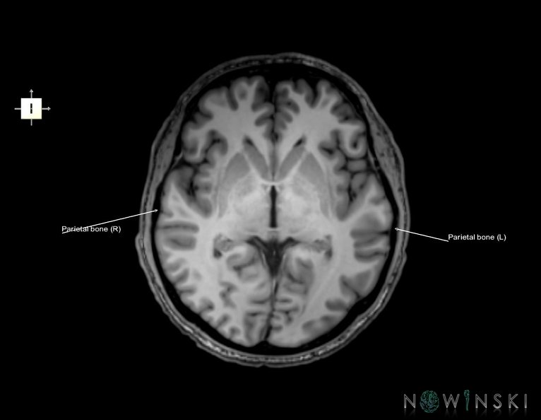 G6.T22.5.7.V6.P00.Parietal_bone–Triplanar.tiff