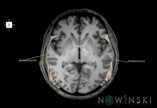 G6.T22.5.7.V6.P00S.Parietal bone–Triplanar