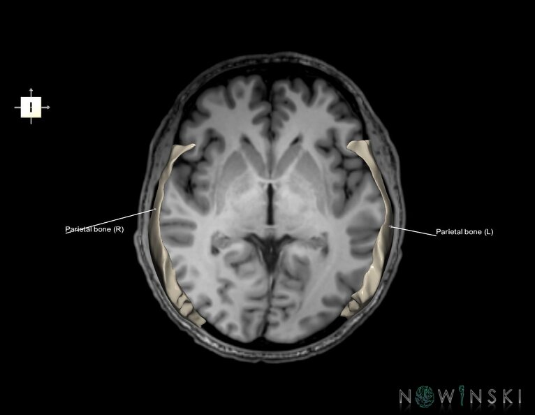 G6.T22.5.7.V6.P00S.Parietal_bone–Triplanar.tiff