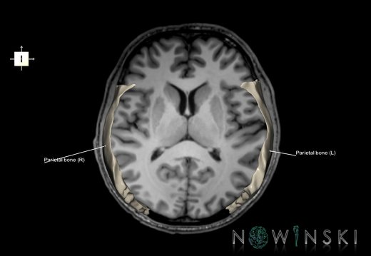 G6.T22.5.7.V6.P10S.Parietal bone–Triplanar