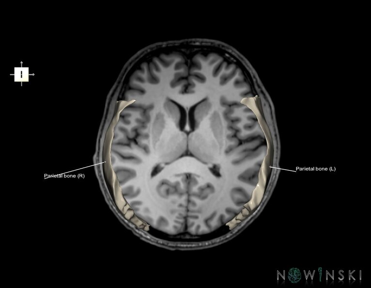 G6.T22.5.7.V6.P10S.Parietal_bone–Triplanar.tiff