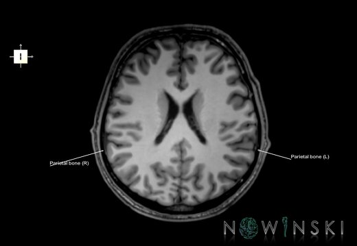 G6.T22.5.7.V6.P20.Parietal bone–Triplanar