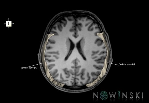 G6.T22.5.7.V6.P20S.Parietal bone–Triplanar