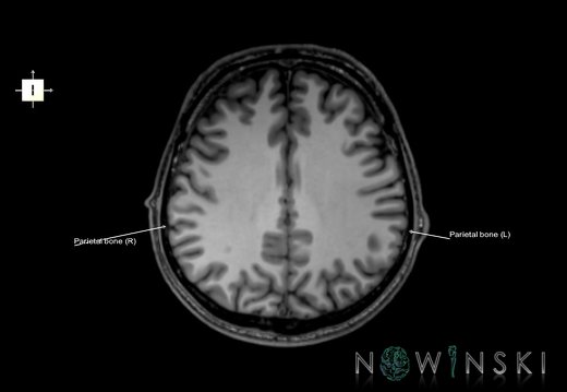 G6.T22.5.7.V6.P30.Parietal bone–Triplanar