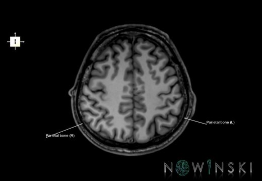 G6.T22.5.7.V6.P40.Parietal bone–Triplanar