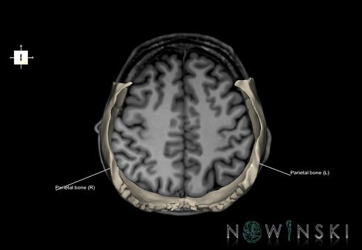 G6.T22.5.7.V6.P40S.Parietal bone–Triplanar