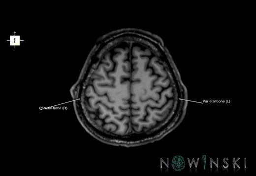 G6.T22.5.7.V6.P50.Parietal bone–Triplanar