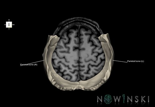 G6.T22.5.7.V6.P50S.Parietal bone–Triplanar