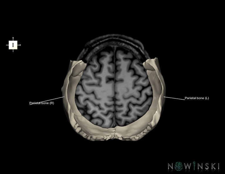 G6.T22.5.7.V6.P50S.Parietal_bone–Triplanar.tiff