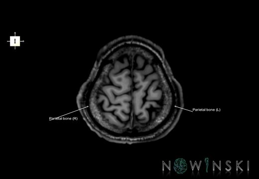 G6.T22.5.7.V6.P60.Parietal bone–Triplanar