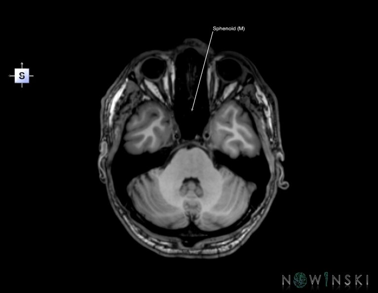 G6.T22.5.8.V5.P-30.Sphenoid–Triplanar.tiff