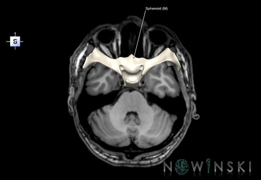 G6T22.5.8.Sphenoid–Triplanar