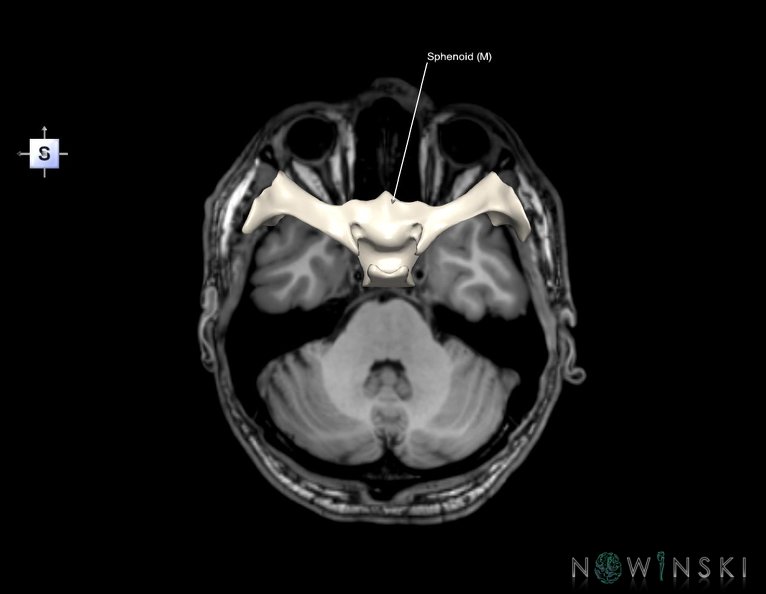 G6.T22.5.8.V5.P-30S.Sphenoid–Triplanar.tiff