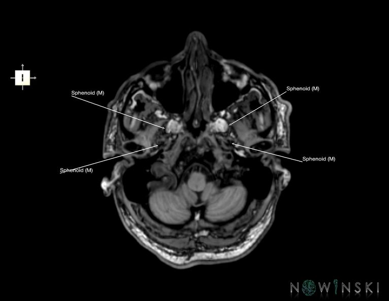 G6.T22.5.8.V6.P-50.Sphenoid–Triplanar.tiff