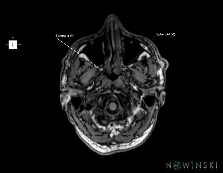 G6.T22.5.8.V6.P-60.Sphenoid–Triplanar.tiff