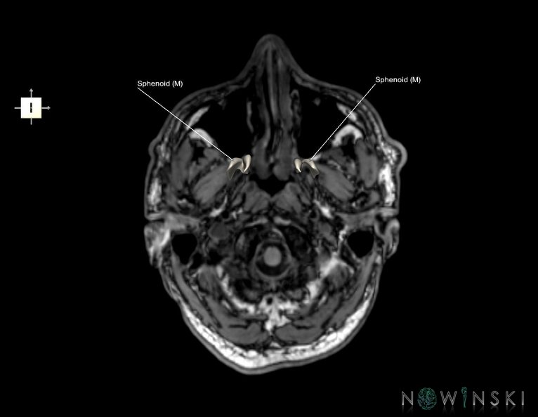 G6.T22.5.8.V6.P-60S.Sphenoid–Triplanar.tiff