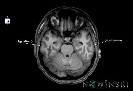 G6T22.5.9.TemporalBone–Triplanar