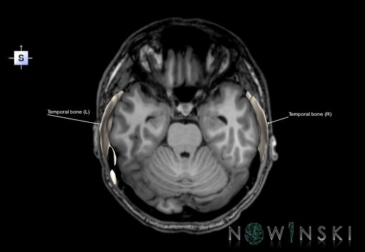 G6.T22.5.9.V5.P-20S.Temporal bone–Triplanar