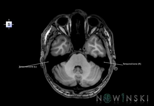 G6.T22.5.9.V5.P-30.Temporal bone–Triplanar