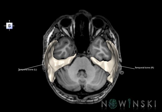 G6.T22.5.9.V5.P-30S.Temporal bone–Triplanar