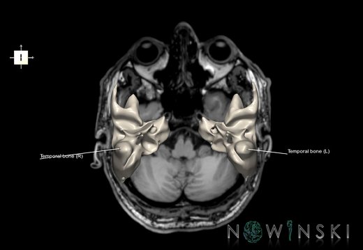 G6.T22.5.9.V6.P-40S.Temporal bone–Triplanar