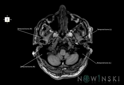 G6.T22.5.9.V6.P-50.Temporal bone–Triplanar