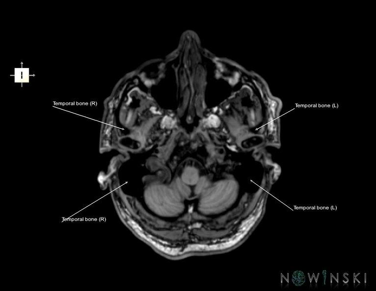 G6.T22.5.9.V6.P-50.Temporal_bone–Triplanar.tiff