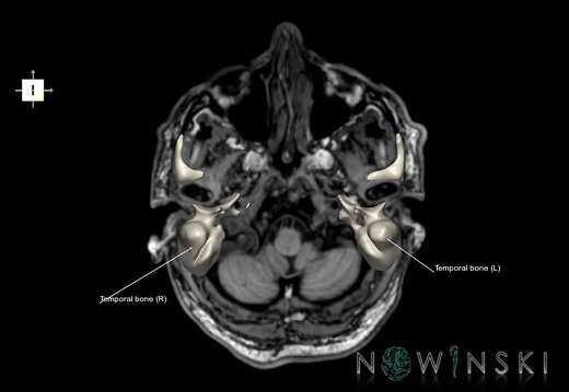 G6.T22.5.9.V6.P-50S.Temporal bone–Triplanar