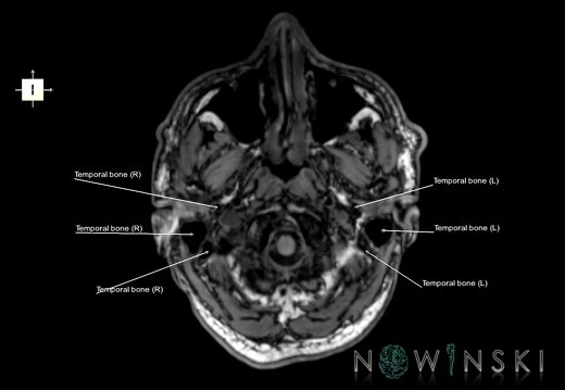 G6.T22.5.9.V6.P-60.Temporal bone–Triplanar