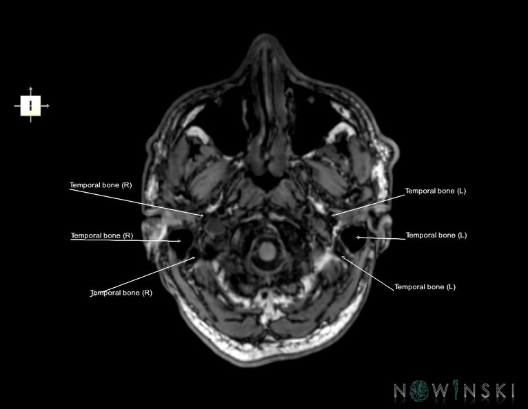 G6.T22.5.9.V6.P-60.Temporal_bone–Triplanar.tiff