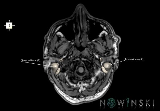 G6.T22.5.9.V6.P-60S.Temporal bone–Triplanar