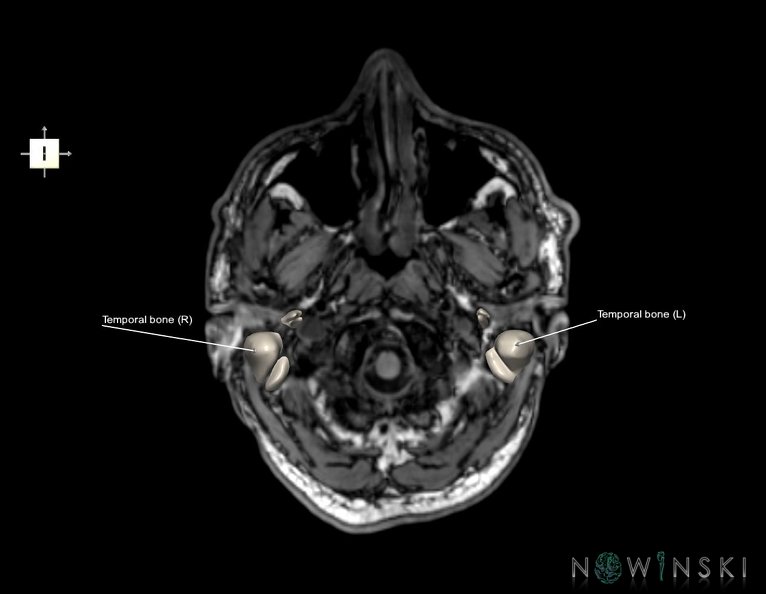 G6.T22.5.9.V6.P-60S.Temporal_bone–Triplanar.tiff