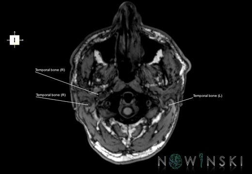 G6.T22.5.9.V6.P-70.Temporal bone–Triplanar