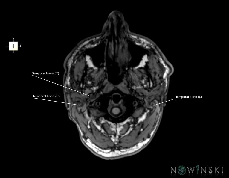 G6.T22.5.9.V6.P-70.Temporal_bone–Triplanar.tiff