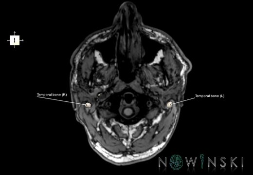 G6.T22.5.9.V6.P-70S.Temporal bone–Triplanar