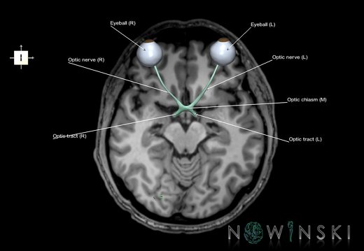 G6.T26.V6.P-10S.Visual system–Triplanar